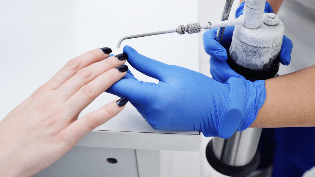 Cryotherapy wart removal