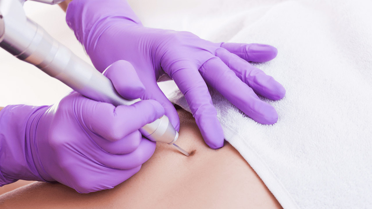 Cryotherapy wart removal