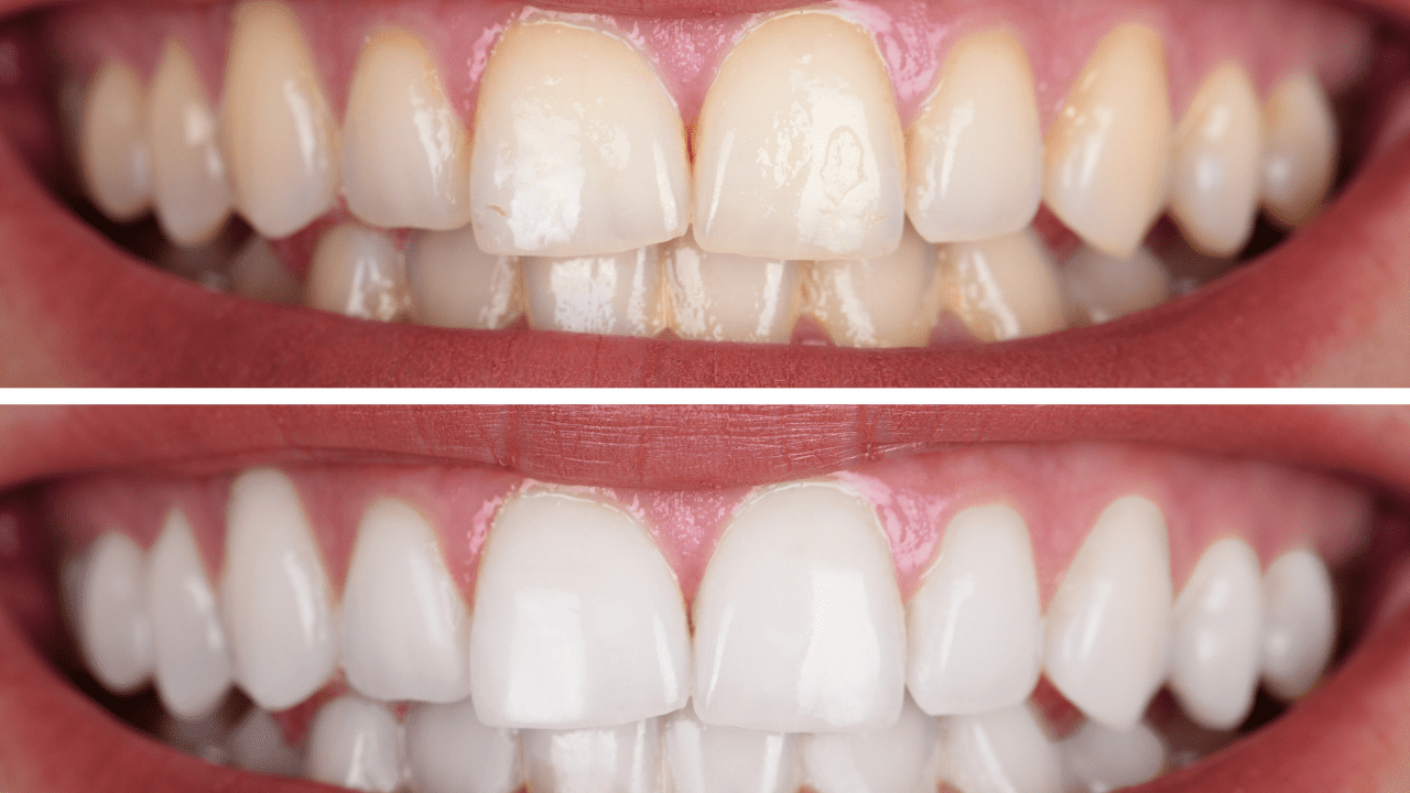 teeth whitening